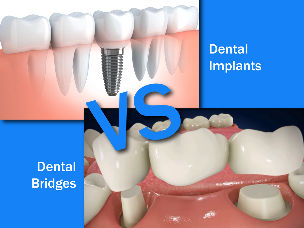 bridge vs dental implant