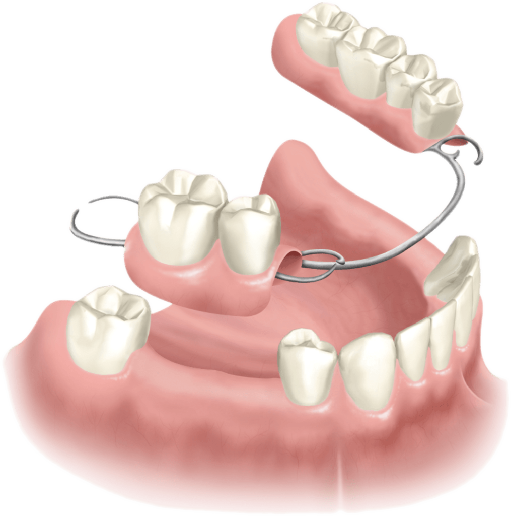 nobel biocare partial-denture