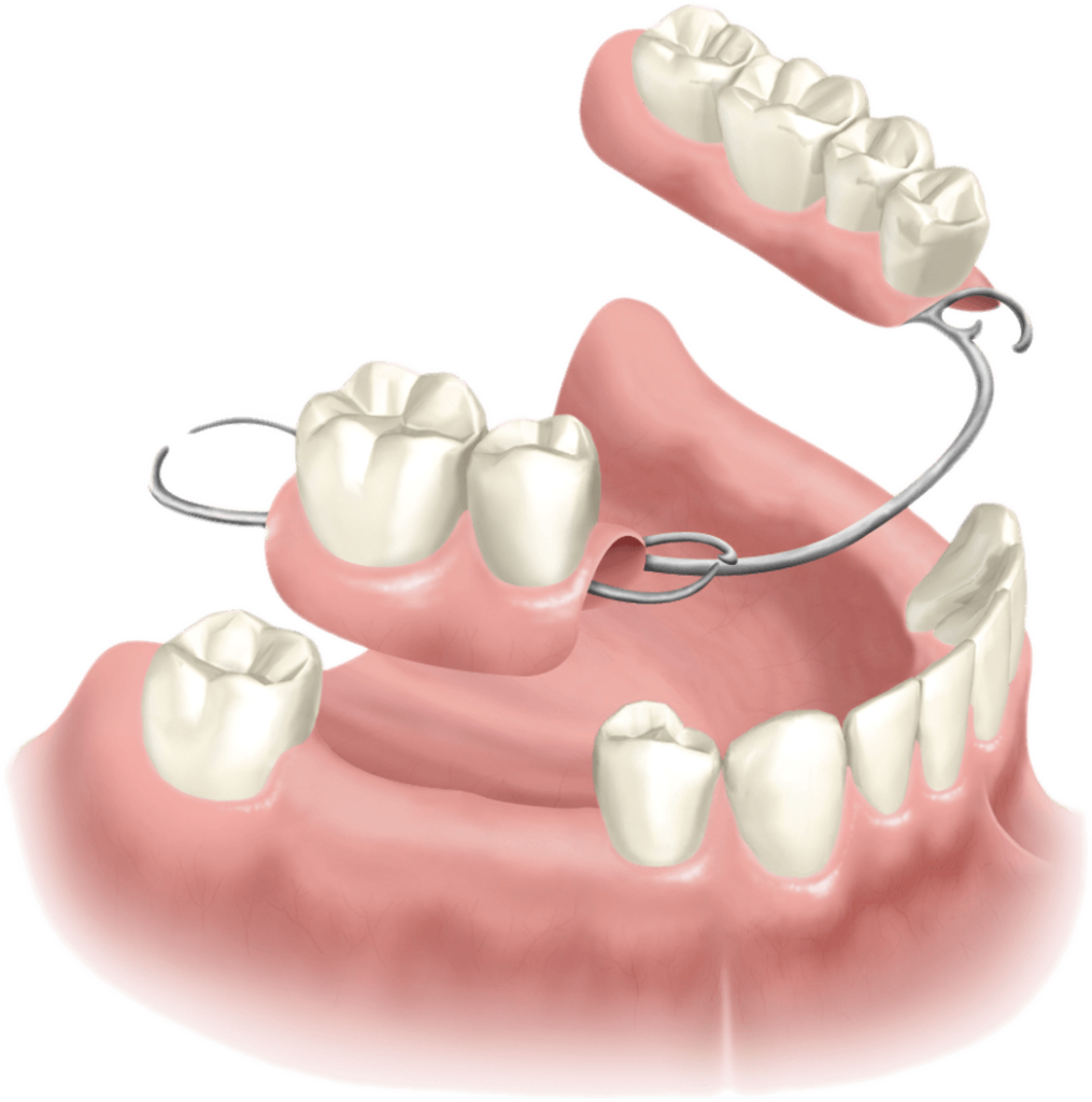 nobel biocare partial-denture