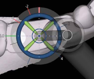 x-guide by x-nav technology allows for easier dental implant placing