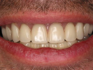 patient after new teeth new life dental implant surgery