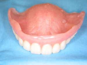 new teeth new life all-on-4 dental implants are a great denture alternative