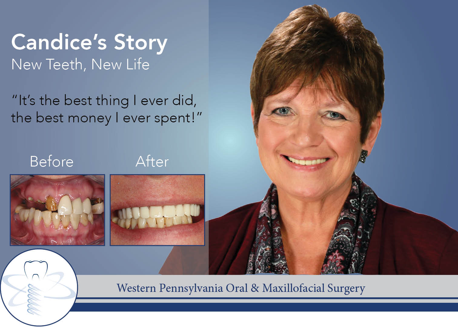 all-on-4 dental implants