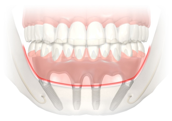 all-on-4 dental implants nobel biocare