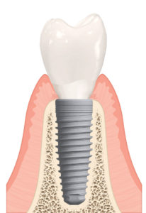dr. krakora dental implant
