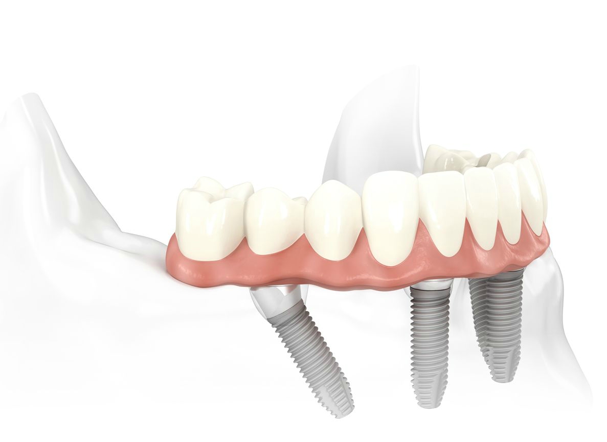 all-on-4 dental implants