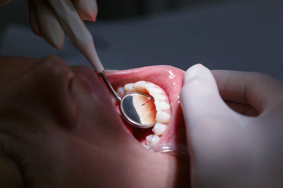 soft tissue grafting to help receding gum line