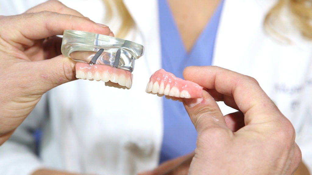all-on-4 dental implants vs. denture