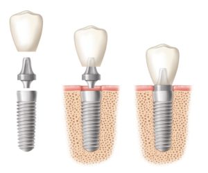 Dental-Implants-AAID