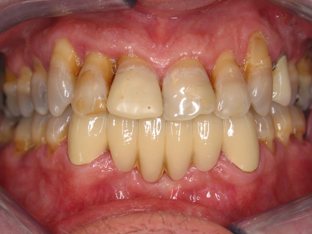 patient before picture for new teeth new life all-on-4 surgery