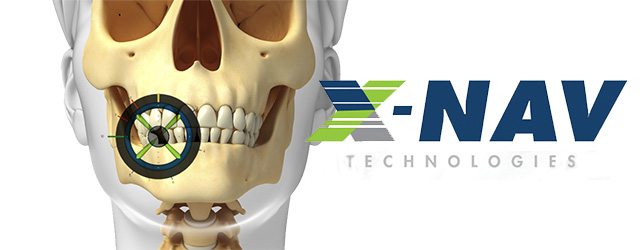 x-nav x-guide dental implant technology