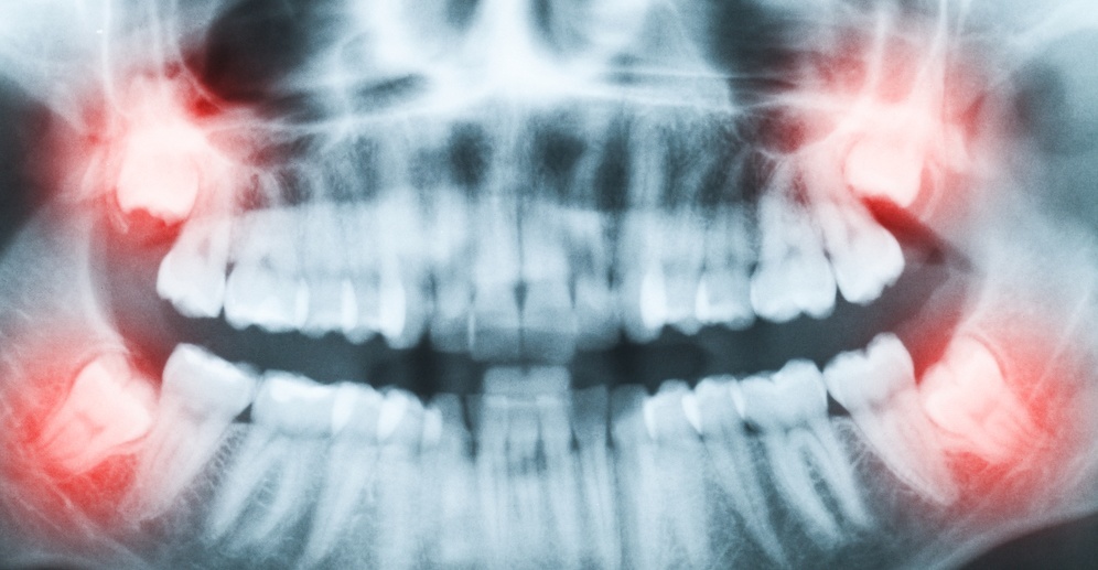 impacted third molars