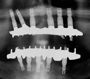 dental implants pittsburgh