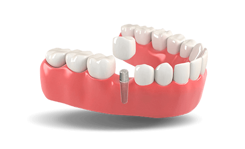 Dental implants model