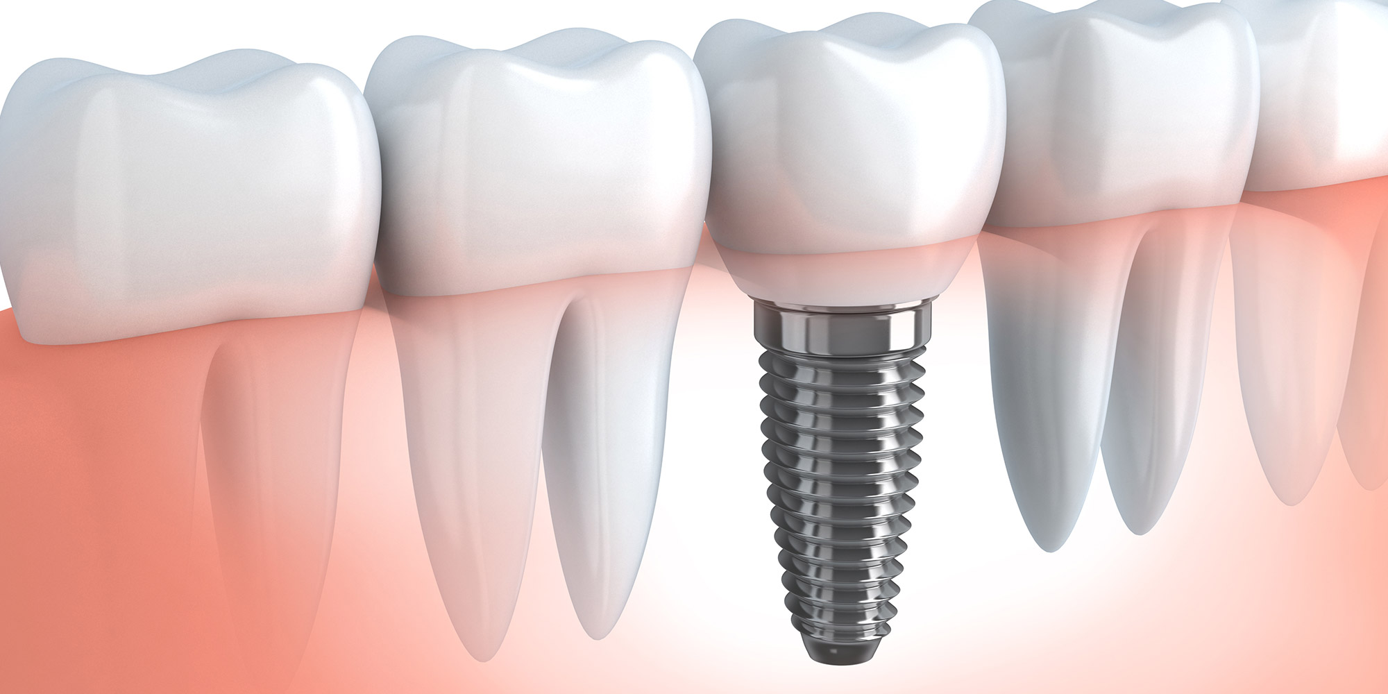 About Dental Implants Washington, PA Steubenville, OH