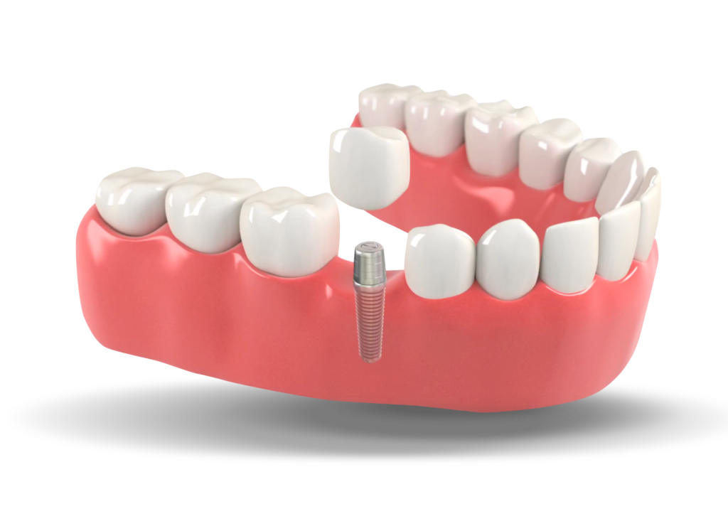 Dental implant