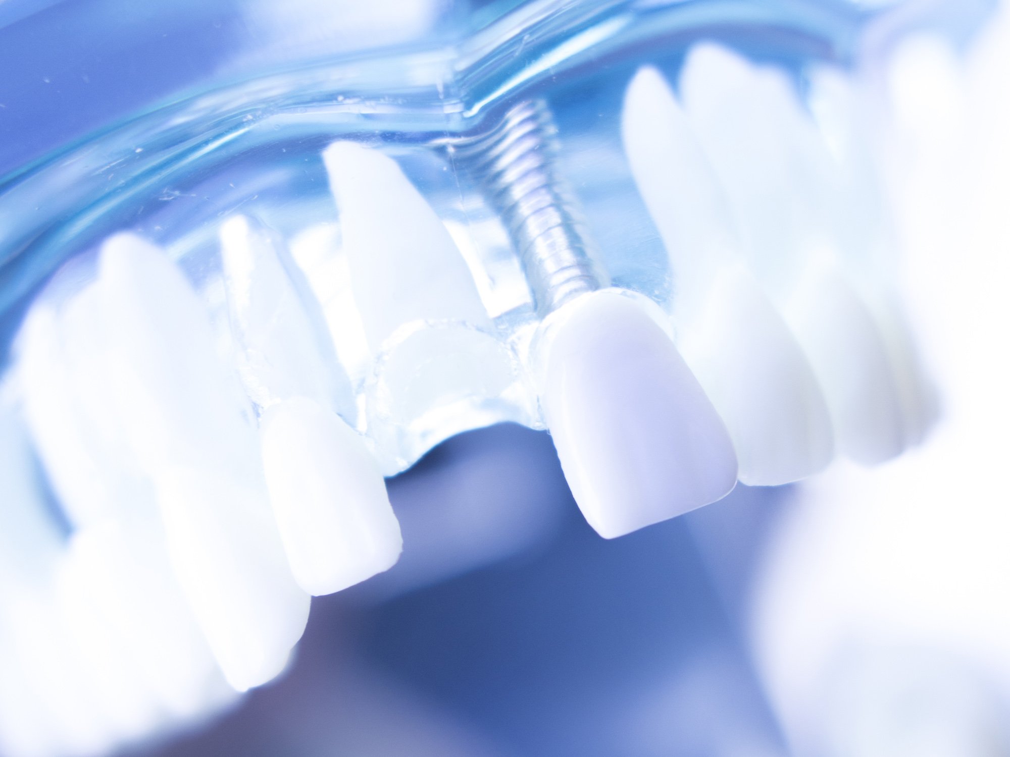 Implants in the Aesthetic Zone Western Pennsylvania & Ohio Valley