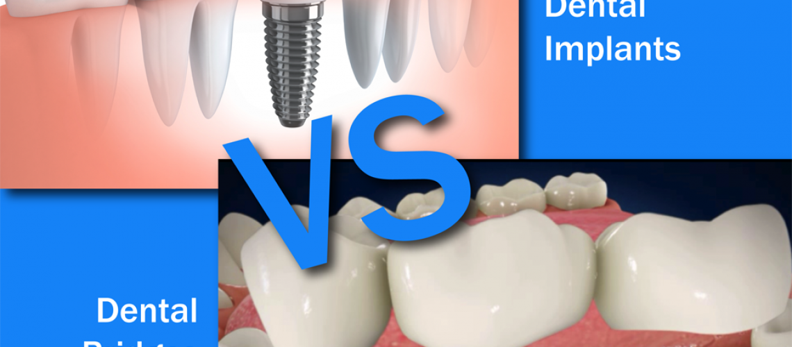 dental implants vs. dental bridges