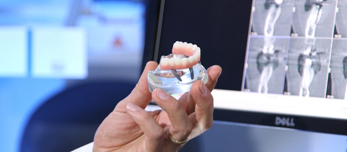 all-on-4 dental implants by dr. krakora