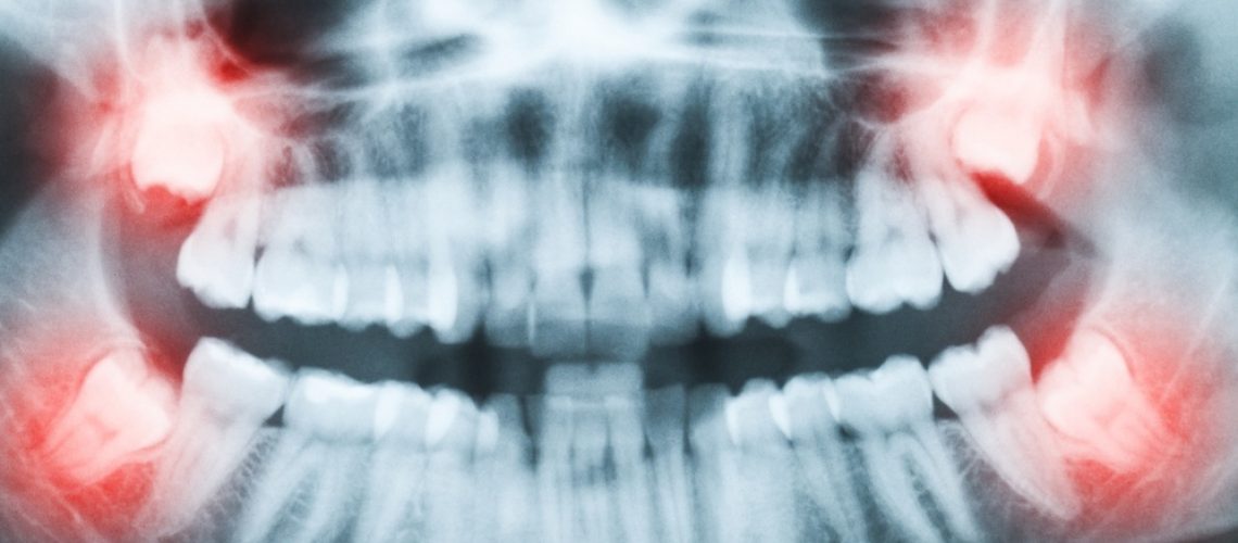 wisdom-teeth-removal