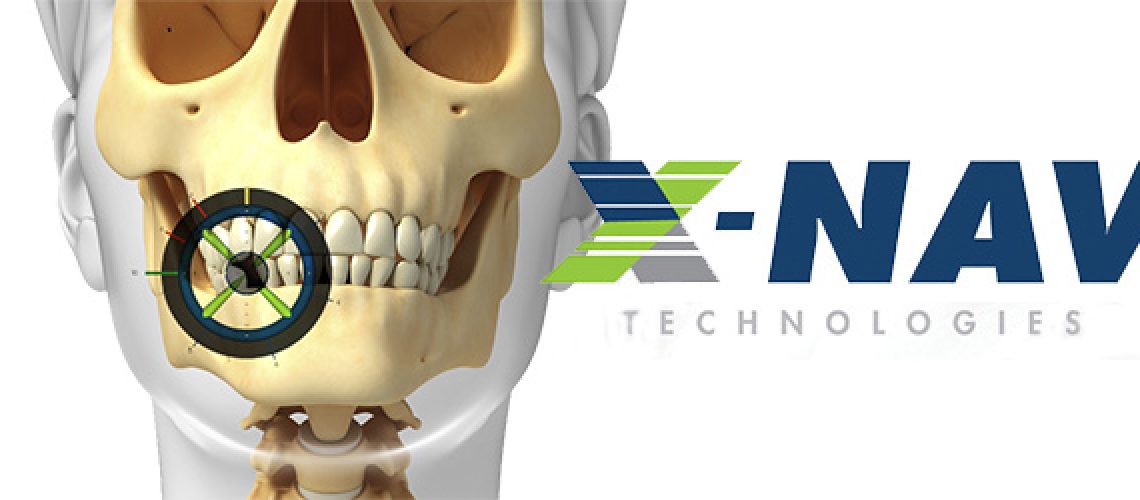 x-nav x-guide dental implant technology